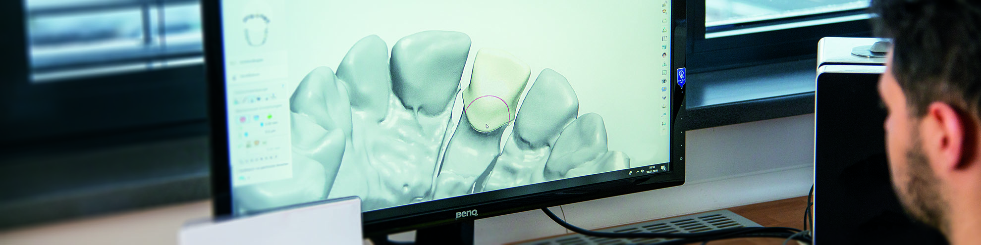 EF Dental-Prothese Modelieren