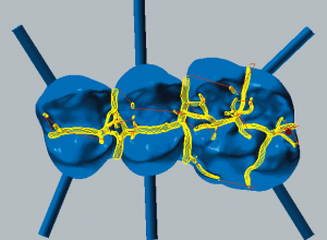 Cobalt-chrome Fissure machining