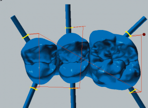 Cobalt-chrome Cut / reduce connectors 