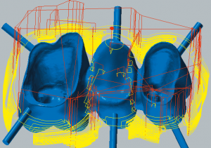 Cobalt-chrome Roughing cavity side 