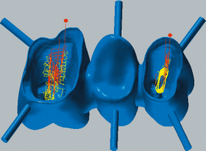 Cobalt-chrome Restmachining inside copings 