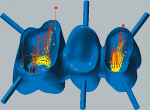 Cobalt-chrome Restmachining inside copings 