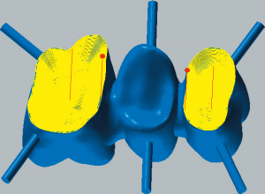 Cobalt-chrome Finishing inside copings