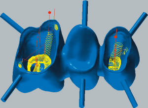 Cobalt-chrome Restmachining inside copings