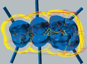 Cobalt-chrome Roughing occlusal side