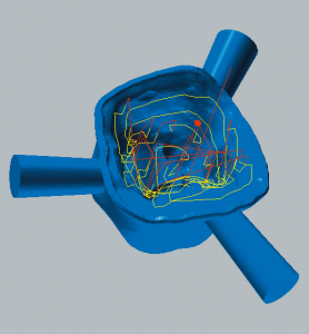 Zirconium oxide and PMMA / PEEK / wax Restmachining inside copings