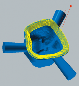 Zirconium oxide and PMMA / PEEK / wax Margin line finishing