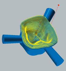 Zirconium oxide and PMMA / PEEK / wax Finishing cavity side