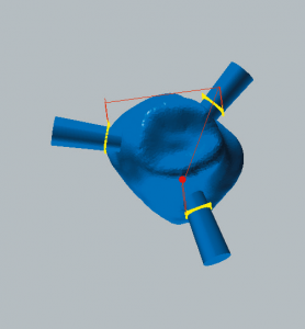 Zirconium oxide and PMMA / PEEK / wax Separating and reducing the connectors